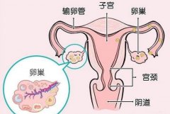引起卵巢性不孕的因素有哪些?