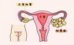 身体的四个症状在提示你有卵巢囊肿