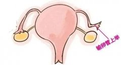 女性输卵管上举会导致不孕吗?