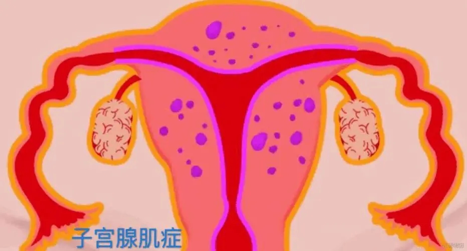 患了子宫腺肌症能怀孕吗？
